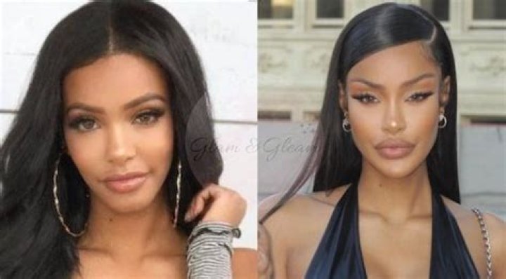 Yodit Yemane plastic Surgery